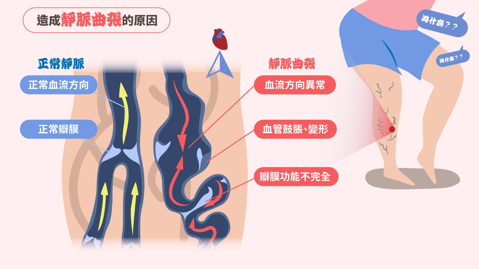 靜脈曲張的原因